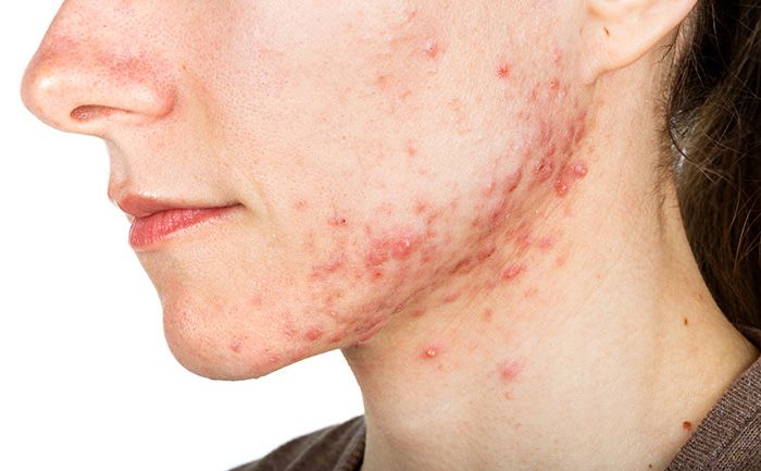 Trattamento acne con terapia biofotonica