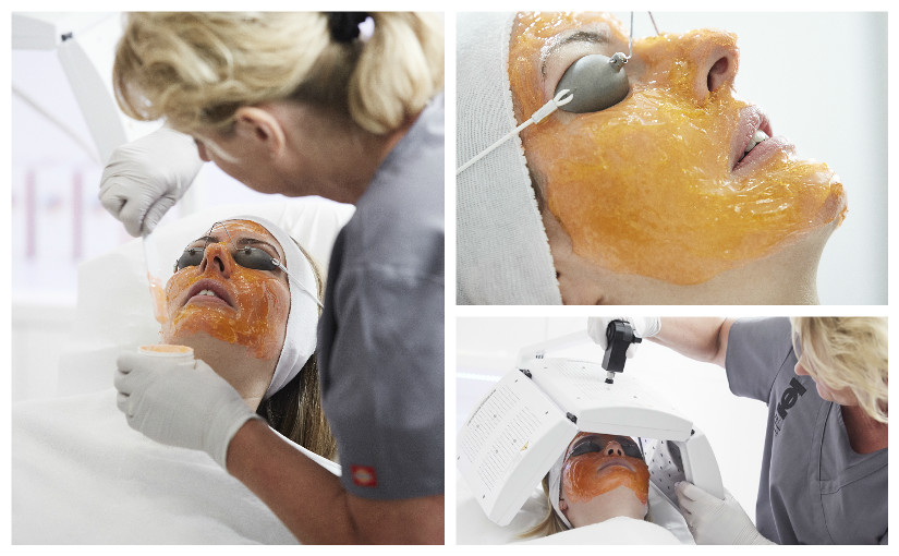 terapia biofotonica acne