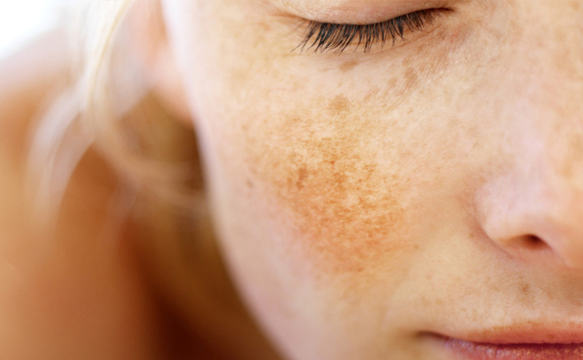 Melasma e macchie solari
