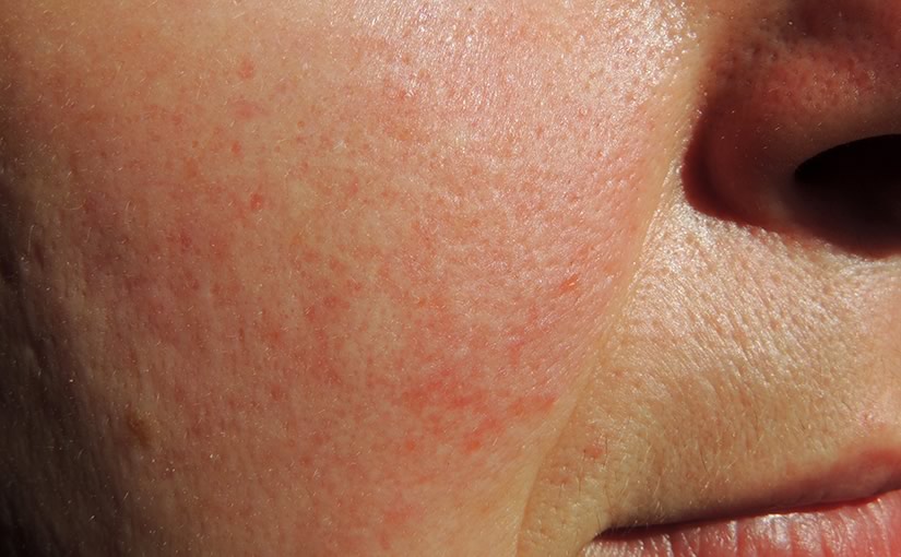 Rosacea: sintomi e trattamento