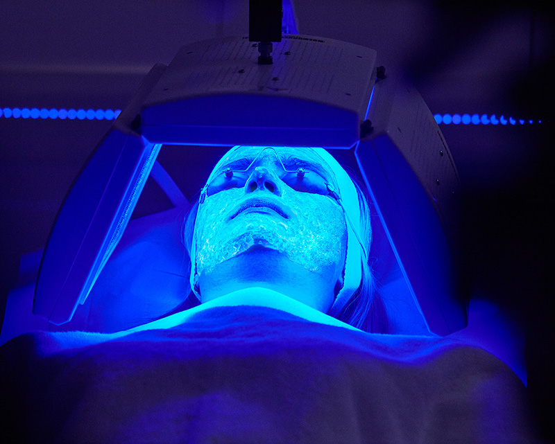 Terapia biofotonica per la cura dell'acne