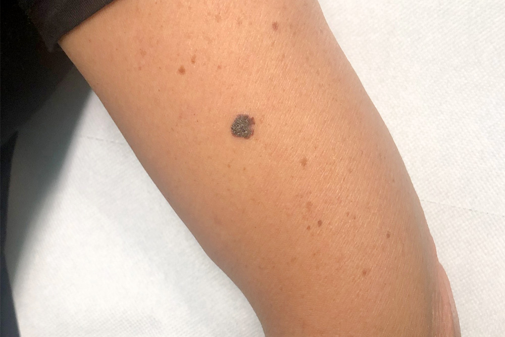 melanoma come prevenirlo